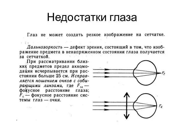 Недостатки глаза