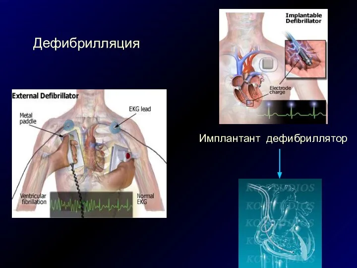 Дефибрилляция