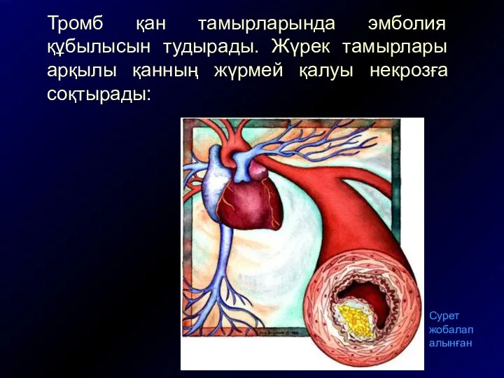 Тромб қан тамырларында эмболия құбылысын тудырады. Жүрек тамырлары арқылы қанның жүрмей қалуы