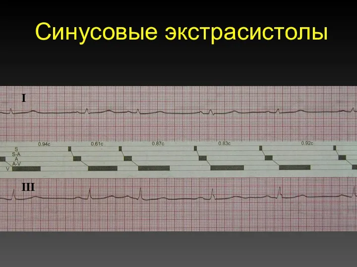 Синусовые экстрасистолы I III