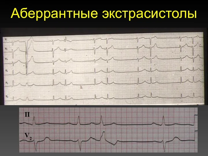 Аберрантные экстрасистолы V2 II