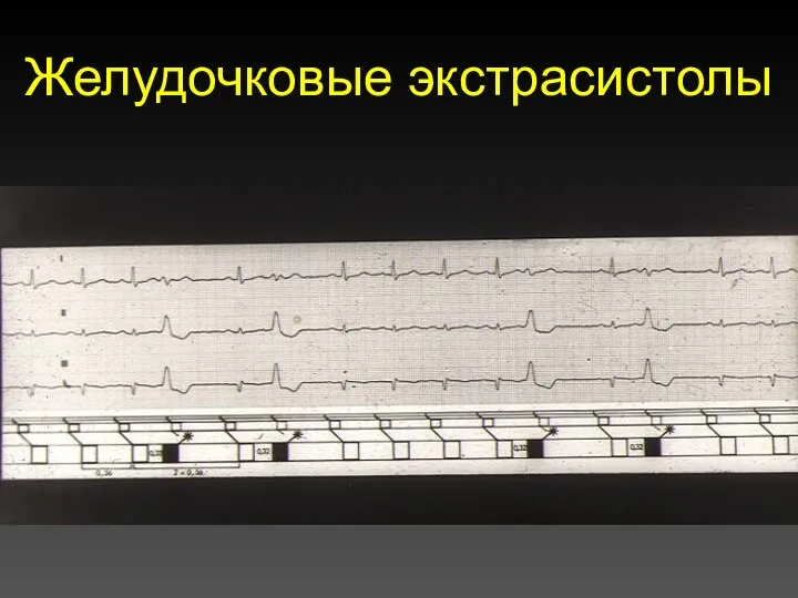 Желудочковые экстрасистолы