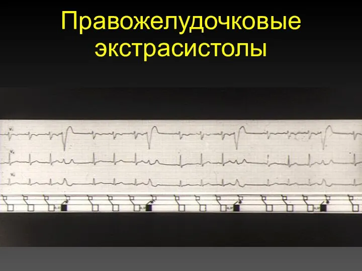 Правожелудочковые экстрасистолы
