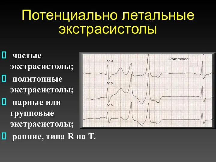 Потенциально летальные экстрасистолы частые экстрасистолы; политопные экстрасистолы; парные или групповые экстрасистолы; ранние, типа R на T.