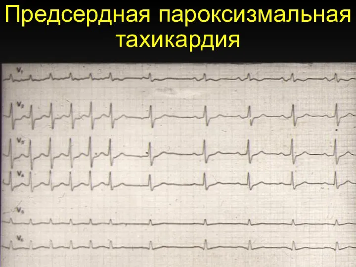 Предсердная пароксизмальная тахикардия