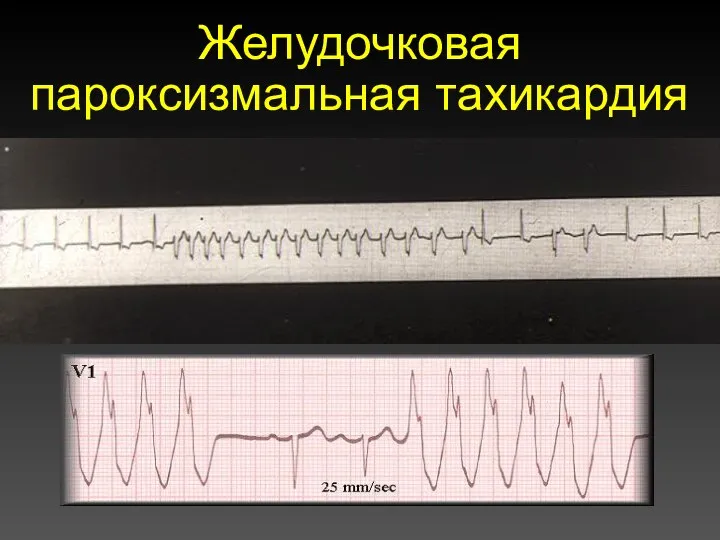 Желудочковая пароксизмальная тахикардия