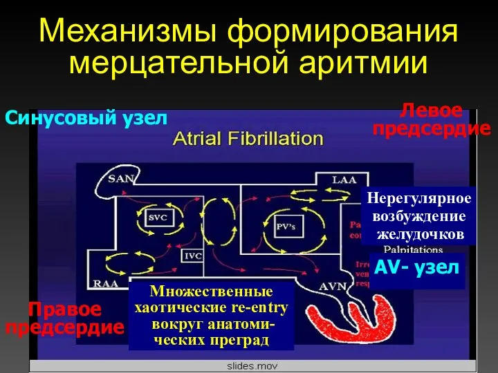 Механизмы формирования мерцательной аритмии Синусовый узел Правое предсердие Левое предсердие АV- узел