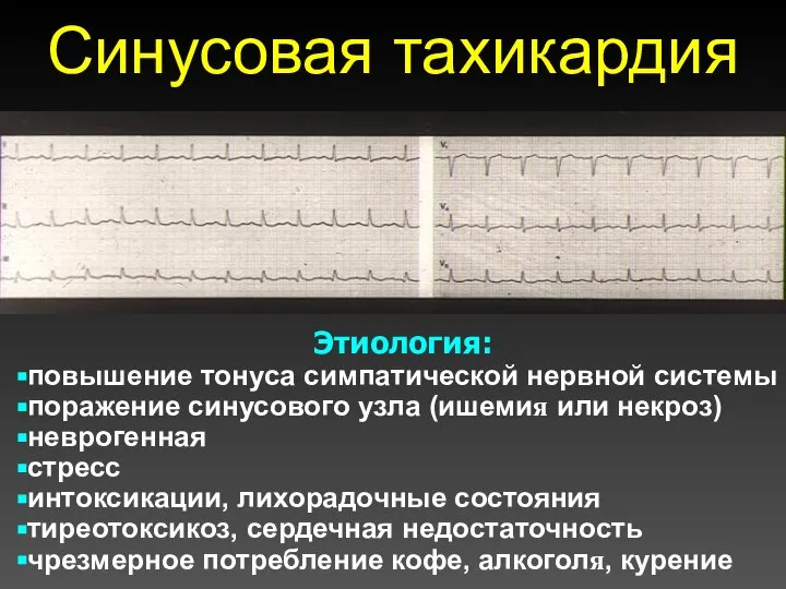 Синусовая тахикардия Этиология: повышение тонуса симпатической нервной системы поражение синусового узла (ишемия