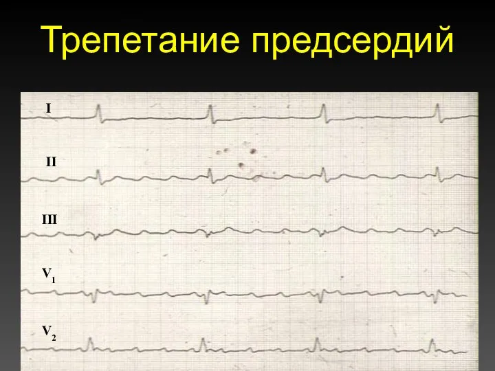 Трепетание предсердий I II III V1 V2