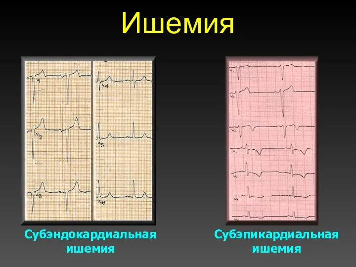 Ишемия Субэндокардиальная ишемия Субэпикардиальная ишемия