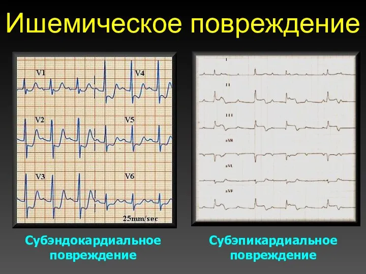 Ишемическое повреждение Субэндокардиальное повреждение Субэпикардиальное повреждение