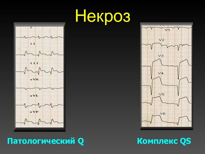 Некроз Патологический Q Комплекс QS