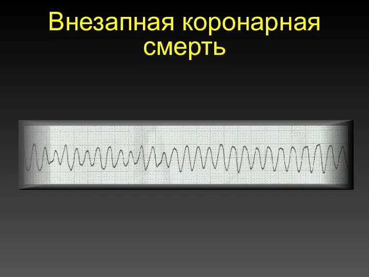 Внезапная коронарная смерть