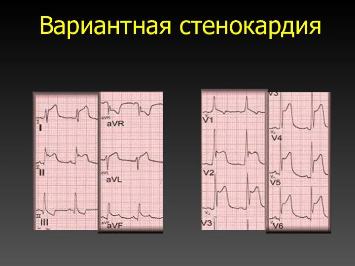 Вариантная стенокардия