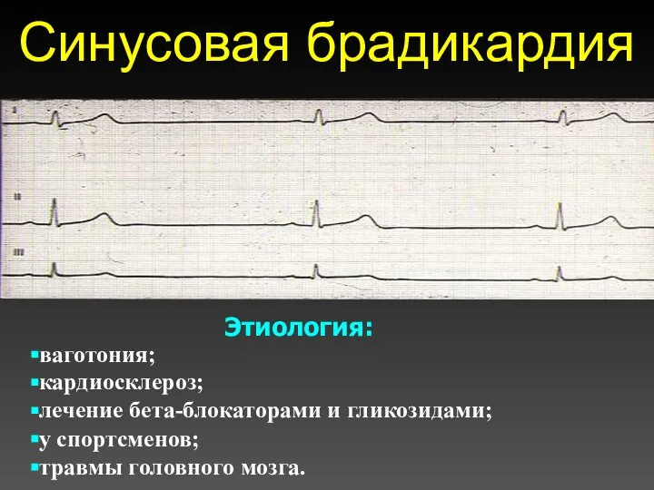 Синусовая брадикардия Этиология: ваготония; кардиосклероз; лечение бета-блокаторами и гликозидами; у спортсменов; травмы головного мозга.