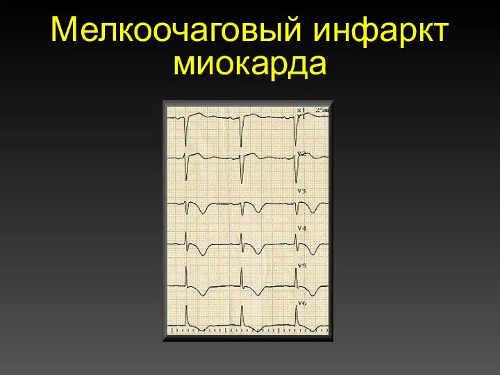 Мелкоочаговый инфаркт миокарда