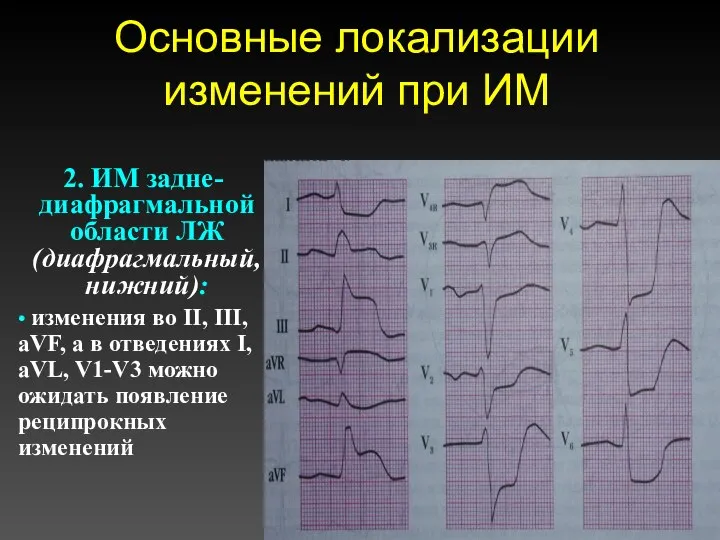 Основные локализации изменений при ИМ 2. ИМ задне-диафрагмальной области ЛЖ (диафрагмальный, нижний):