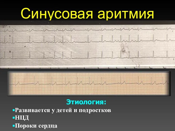 Синусовая аритмия Этиология: Развивается у детей и подростков НЦД Пороки сердца