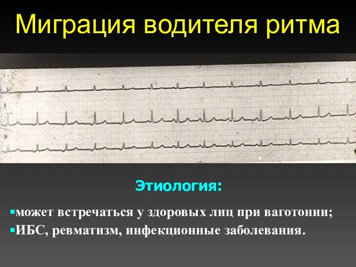 Миграция водителя ритма Этиология: может встречаться у здоровых лиц при ваготонии; ИБС, ревматизм, инфекционные заболевания.