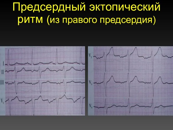 Предсердный эктопический ритм (из правого предсердия)