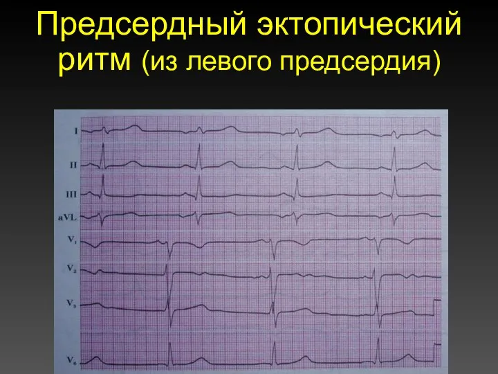 Предсердный эктопический ритм (из левого предсердия)