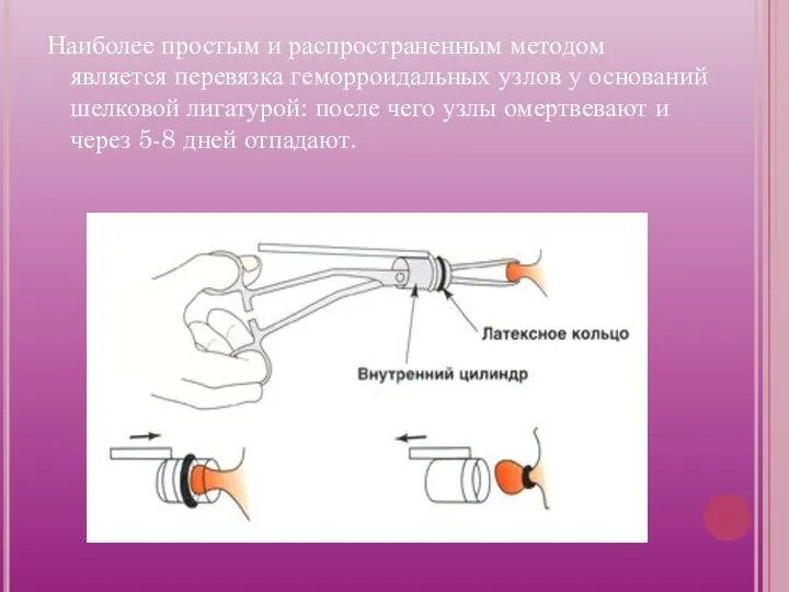 Наиболее простым и распространенным методом является перевязка геморроидальных узлов у оснований шелковой