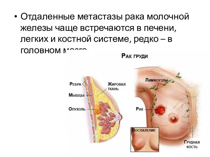 Отдаленные метастазы рака молочной железы чаще встречаются в печени, легких и костной