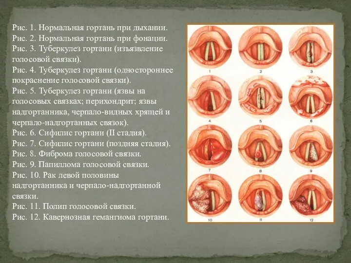 Рис. 1. Нормальная гортань при дыхании. Рис. 2. Нормальная гортань при фонации.