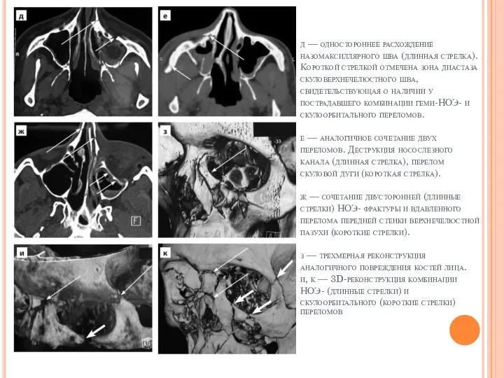 д — одностороннее расхождение назомаксиллярного шва (длинная стрелка). Короткой стрелкой отмечена зона