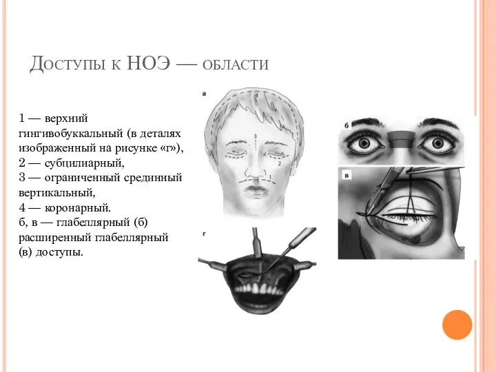 Доступы к НОЭ — области 1 — верхний гингивобуккальный (в деталях изображенный