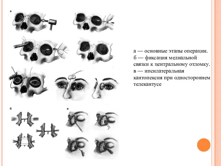 а — основные этапы операции. б — фиксация медиальной связки к центральному