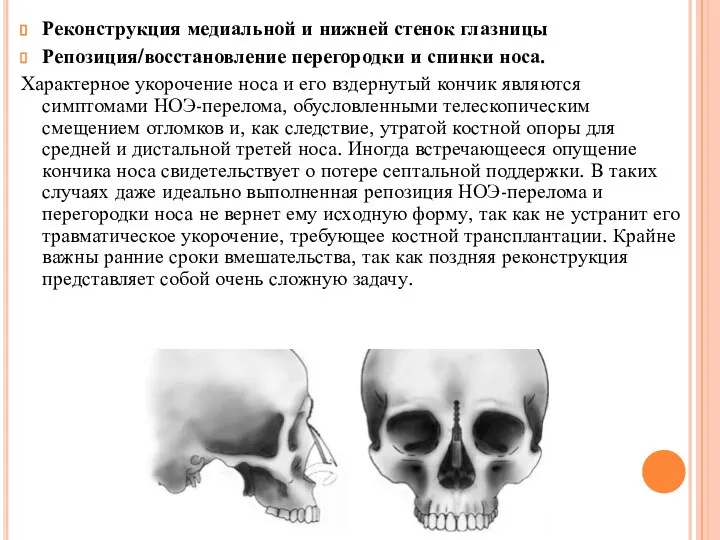 Реконструкция медиальной и нижней стенок глазницы Репозиция/восстановление перегородки и спинки носа. Характерное