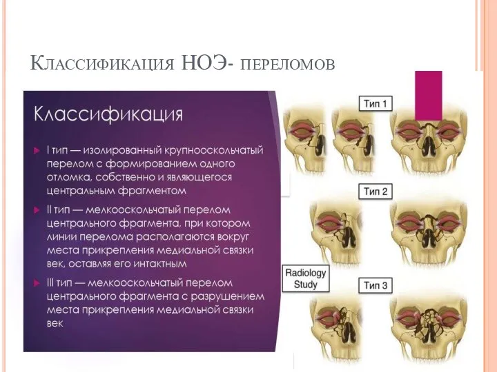 Классификация НОЭ- переломов