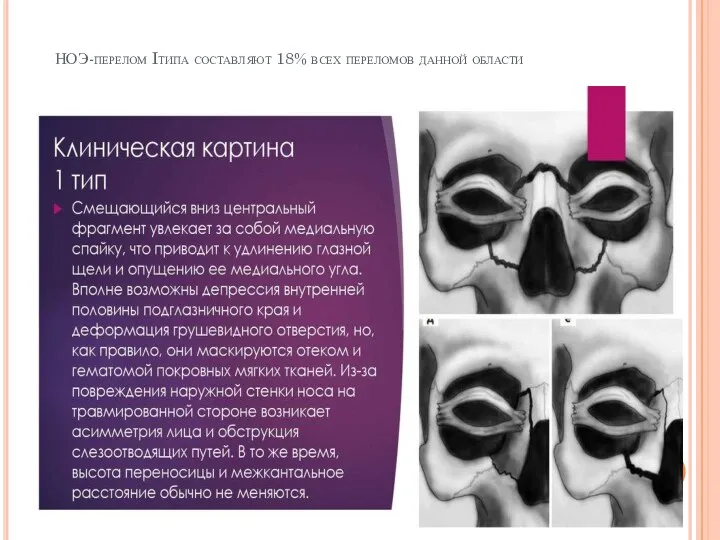 НОЭ-перелом Iтипа составляют 18% всех переломов данной области