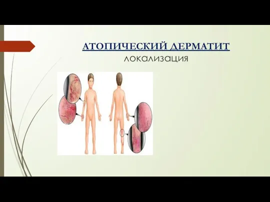 АТОПИЧЕСКИЙ ДЕРМАТИТ локализация