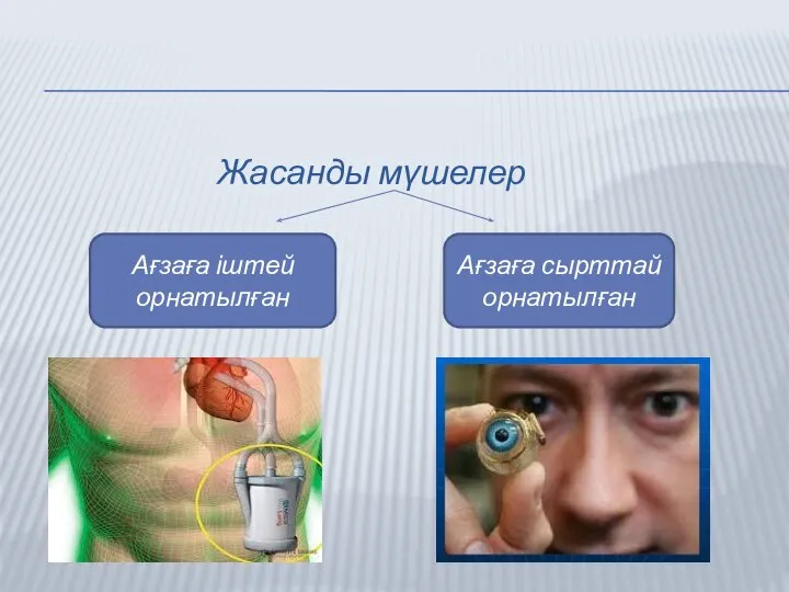 Жасанды мүшелер Ағзаға іштей орнатылған Ағзаға сырттай орнатылған