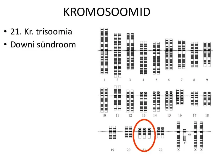 KROMOSOOMID 21. Kr. trisoomia Downi sündroom