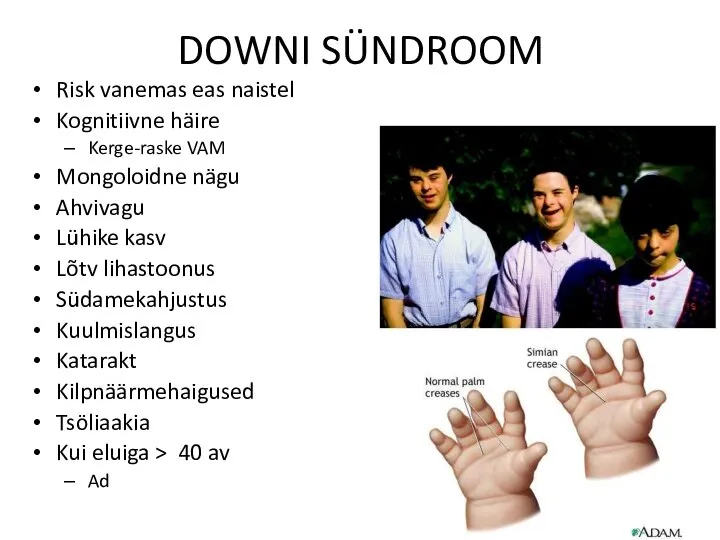 DOWNI SÜNDROOM Risk vanemas eas naistel Kognitiivne häire Kerge-raske VAM Mongoloidne nägu