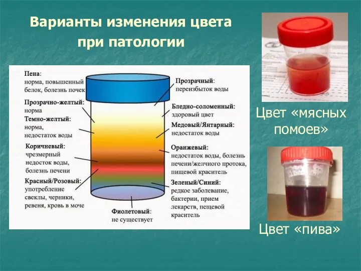 Цвет «пива» Цвет «мясных помоев» Варианты изменения цвета при патологии