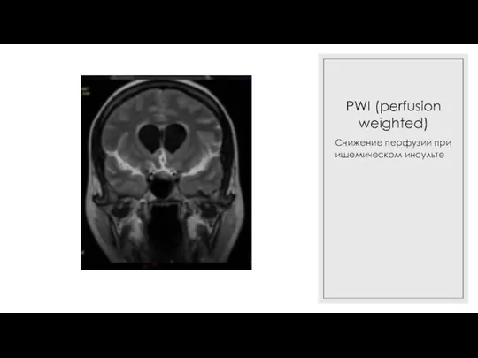 PWI (perfusion weighted) Снижение перфузии при ишемическом инсульте