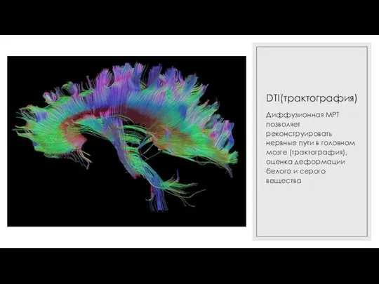 DTI(трактография) Диффузионная МРТ позволяет реконструировать нервные пути в головном мозге (трактография), оценка