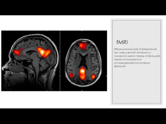 fMRI (Функциональное) определение зон повышенной активности головного мозга перед операцией, также используется в исследованиях когнитивных функций