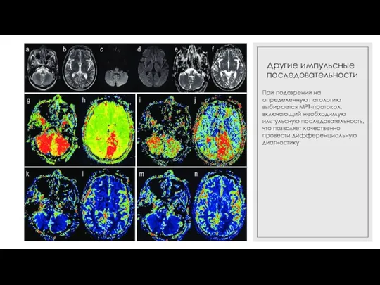 Другие импульсные последовательности При подозрении на определенную патологию выбирается МРТ-протокол, включающий необходимую