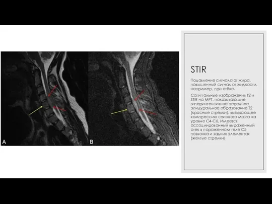 STIR Подавление сигнала от жира, повышенный сигнал от жидкости, например, при отёке.