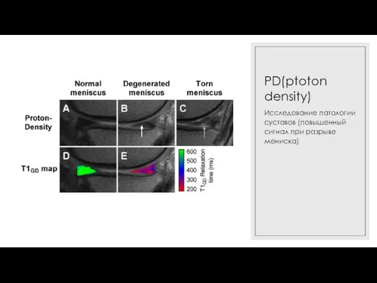 PD(ptoton density) Исследование патологии суставов (повышенный сигнал при разрыве мениска)