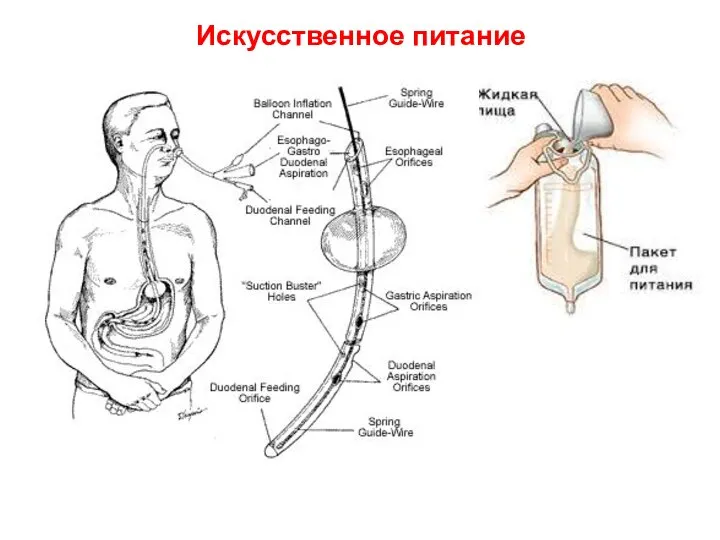 Искусственное питание