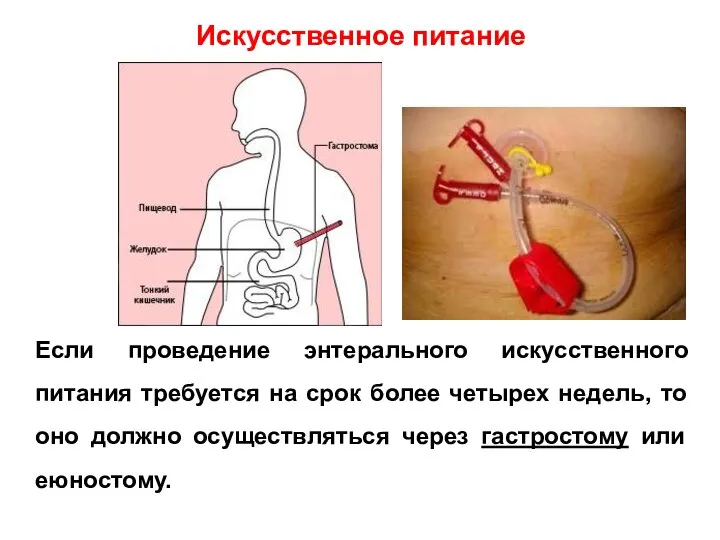 Если проведение энтерального искусственного питания требуется на срок более четырех недель, то