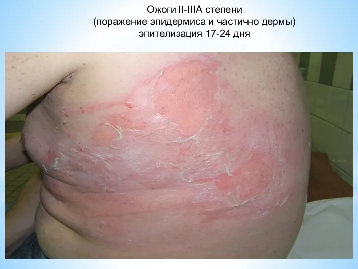 Ожоги II-IIIА степени (поражение эпидермиса и частично дермы) эпителизация 17-24 дня