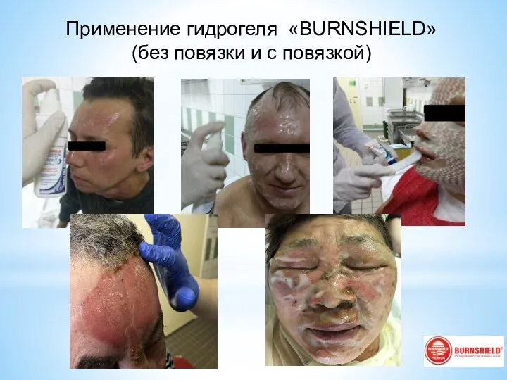 Применение гидрогеля «BURNSHIELD» (без повязки и с повязкой)