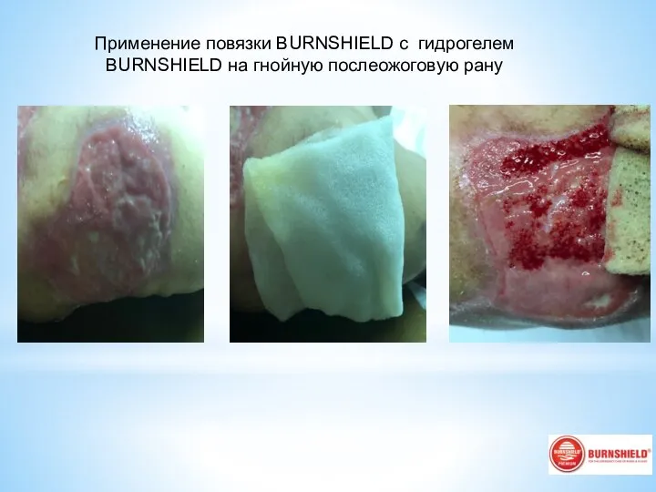 Применение повязки BURNSHIELD с гидрогелем BURNSHIELD на гнойную послеожоговую рану